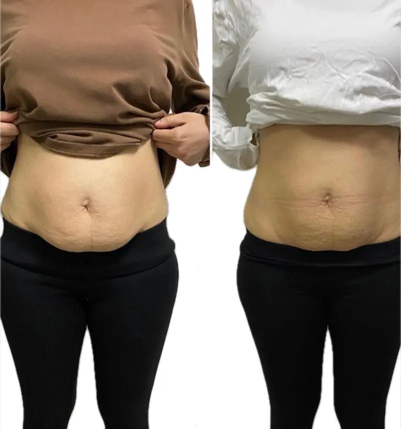Wonder Axon body sculpting results — Belly Fat Reduction