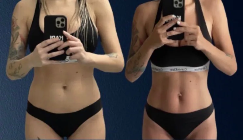 Wonder Axon body sculpting results — Core & Abdomen
