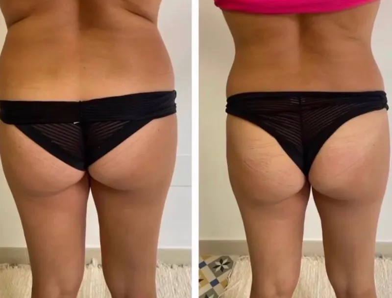 Wonder Axon body sculpting results — Glutes