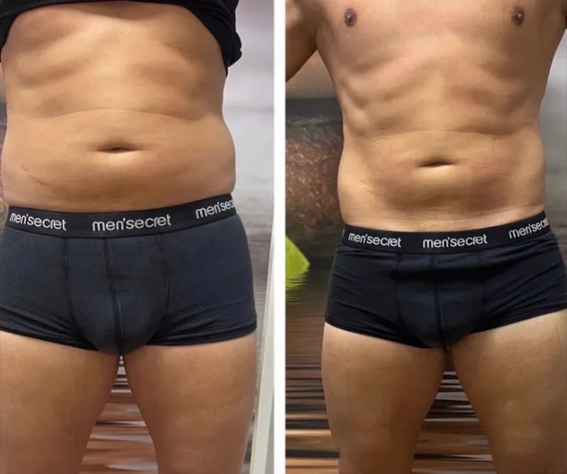 Wonder Axon body sculpting results — Love Handles