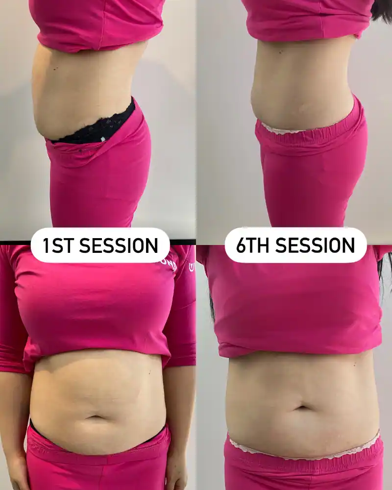 Wonder Axon body sculpting results — Waist